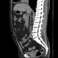 Autosomal dominant polycystic kidney disease (Radiopaedia 36539-38101 D 41).jpg