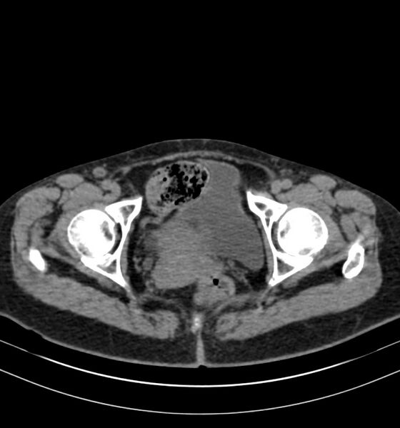 File:Autosomal dominant polycystic kidney disease (Radiopaedia 41918-44922 Axial non-contrast 35).jpg