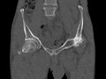 Avascular necrosis of the left hip (Radiopaedia 75068-86125 Coronal bone window 9).jpg