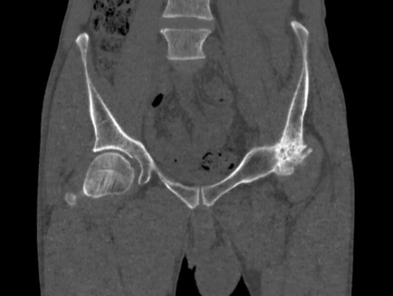 File:Avascular necrosis of the left hip (Radiopaedia 75068-86125 Coronal bone window 9).jpg