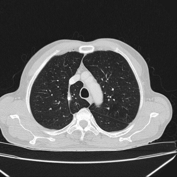 File:Azygos lobe (Radiopaedia 38259-40275 Axial lung window 20).jpg