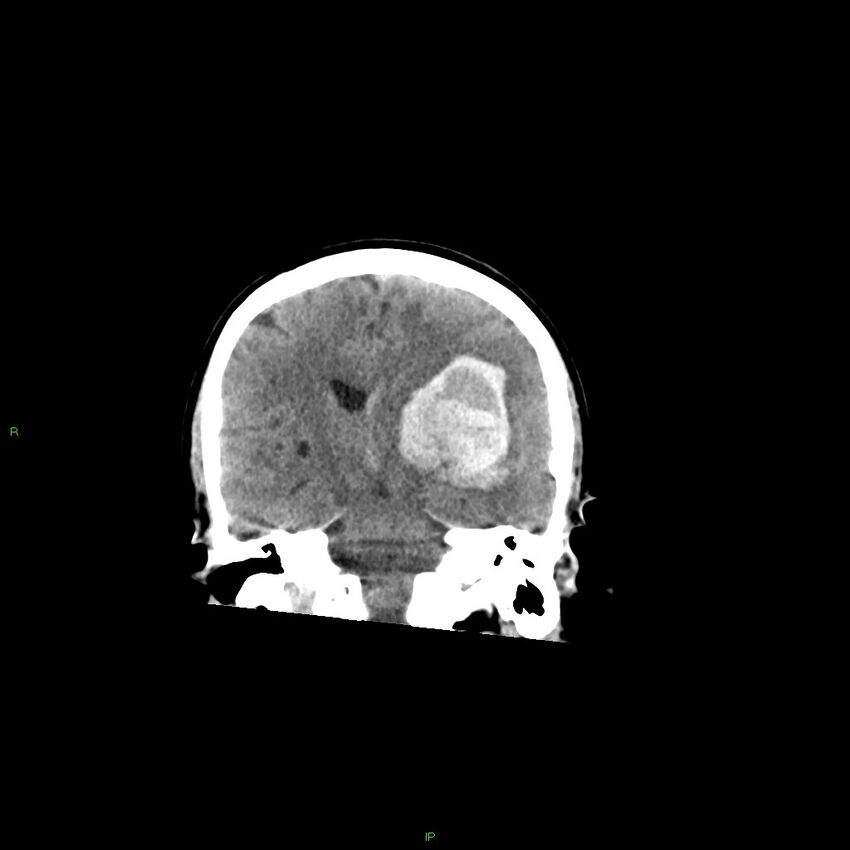 Basal ganglia hemorrhage (Radiopaedia 58349-65472 Coronal non-contrast 33).jpg