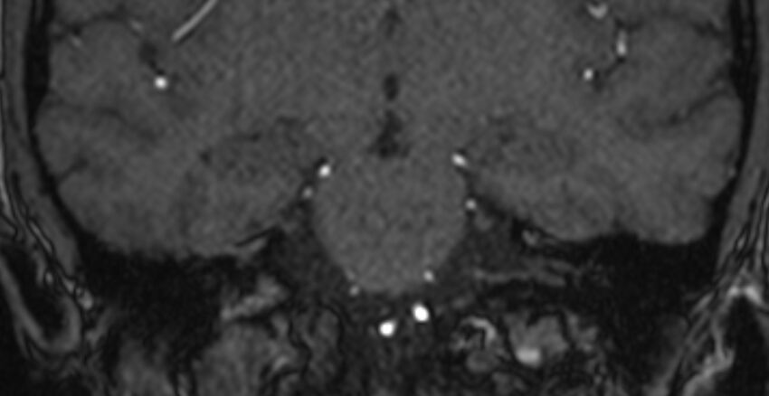 Basilar artery fenestration (Radiopaedia 74537-85455 Coronal MRA TOF 57).jpg