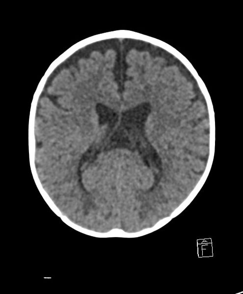 File:Benign enlargement of subarachnoid spaces in infancy (BESS) (Radiopaedia 87459-103795 Axial non-contrast 38).jpg