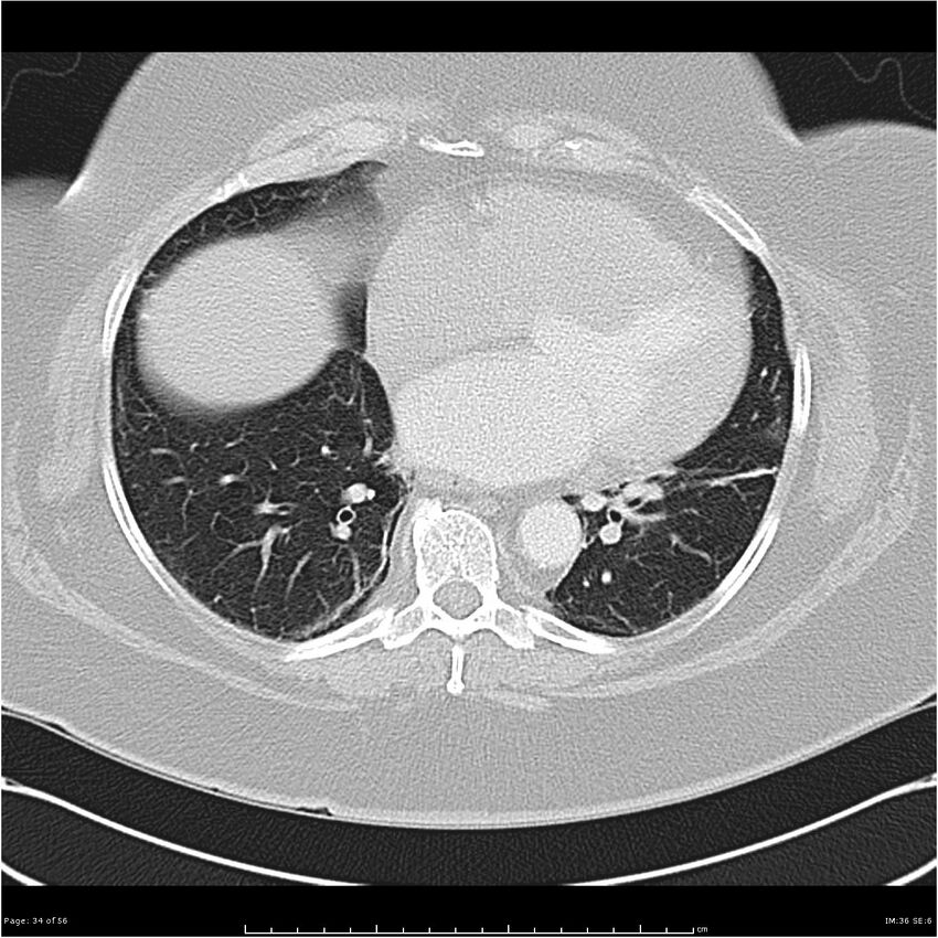Benign metastasizing leiomyoma (Radiopaedia 26803-26962 Axial lung window 34).jpg