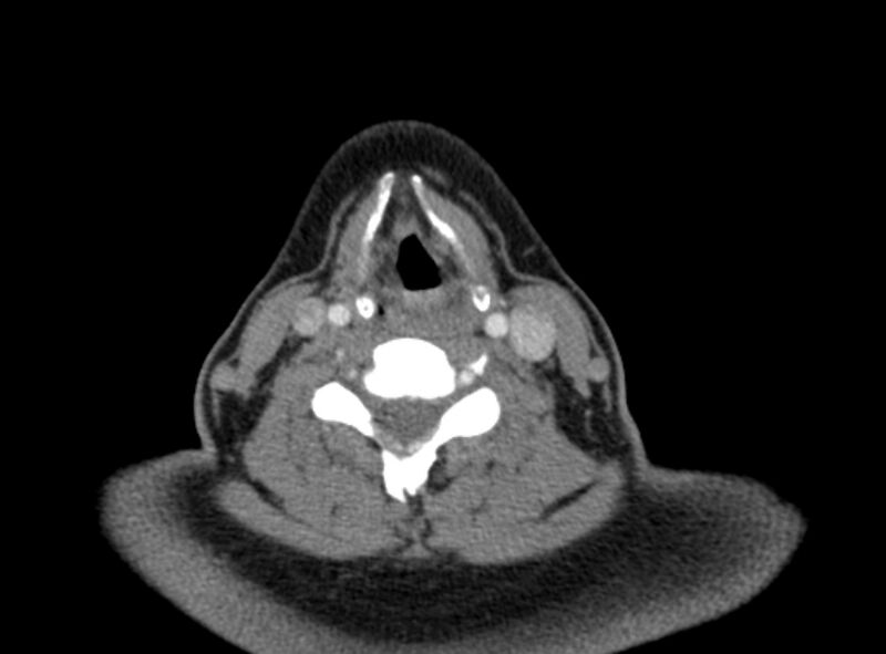 File:Benign mixed salivary tumor of the parotid gland (Radiopaedia 35261-36792 A 34).jpg
