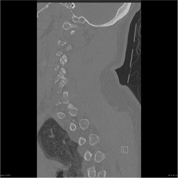 File:Bilateral cervical ribs (Radiopaedia 25868-26017 Sagittal bone window 53).jpg
