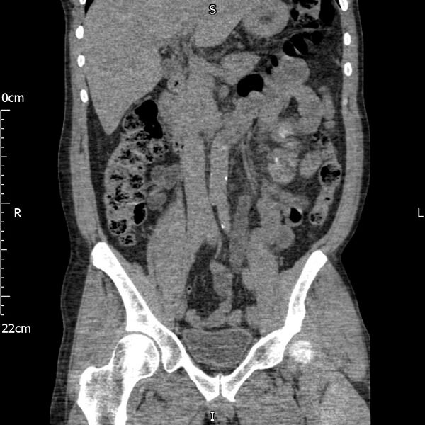 File:Bilateral medullary nephrocalcinosis with ureteric calculi (Radiopaedia 71269-81569 Coronal non-contrast 31).jpg