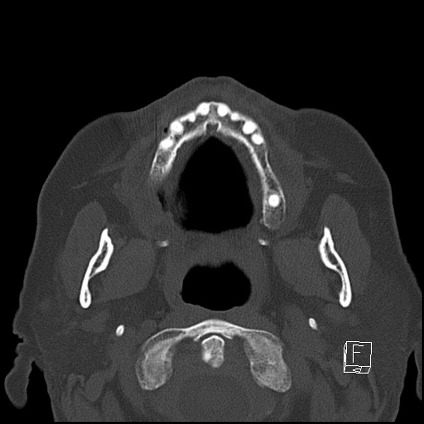 Bilateral palatine tonsilloliths on OPG and CT (Radiopaedia 75167-86247 Axial bone window 33).jpg