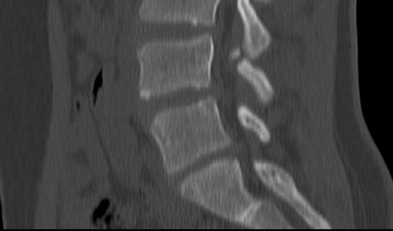 File:Bilateral pars defect (Radiopaedia 26691-26846 Sagittal bone window 27).jpg