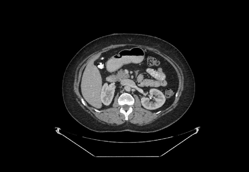File:Bilateral urolithiasis with incidentally detected splenic artery aneurysm and left inferior vena cava (Radiopaedia 44467-48127 B 35).jpg