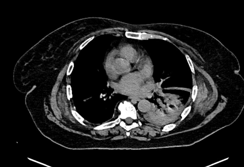 File:Biliary pancreatitis (Radiopaedia 72289-82823 Axial non-contrast 4).jpg