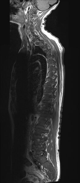 File:Bing-Neel syndrome (Radiopaedia 71453-81799 Sagittal T1 13).jpg