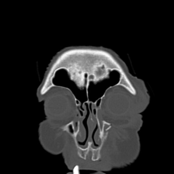 File:Biparietal osteodystrophy (Radiopaedia 46109-50463 Coronal bone window 18).jpg