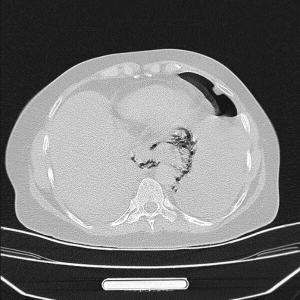 File:Boerhaave syndrome (Radiopaedia 45644-49799 Axial lung window 88).jpg