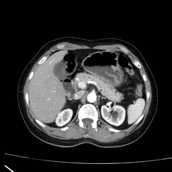File:Bosniak renal cyst - type I (Radiopaedia 27479-27675 renal cortical phase 23).jpg