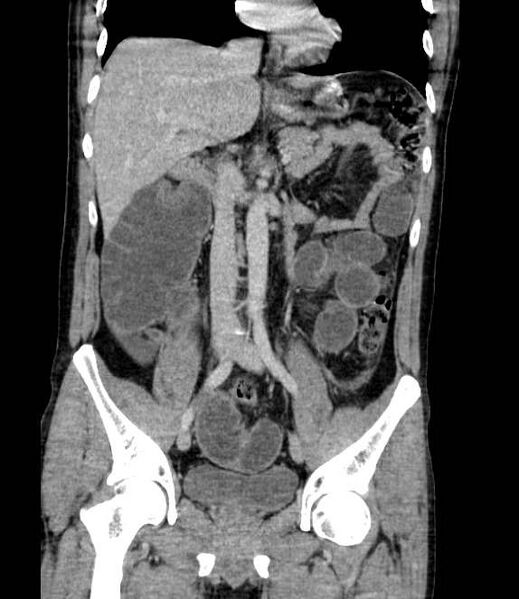 File:Bowel obstruction from colon carcinoma (Radiopaedia 22995-23028 C 38).jpg
