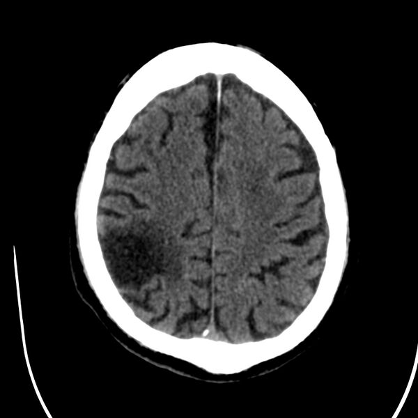 File:Brain Pantopaque remnants (Radiopaedia 78403-91048 Axial non-contrast 67).jpg