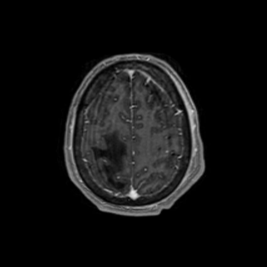 Brain abscess complicated by intraventricular rupture and ventriculitis (Radiopaedia 82434-96577 Axial T1 C+ 59).jpg