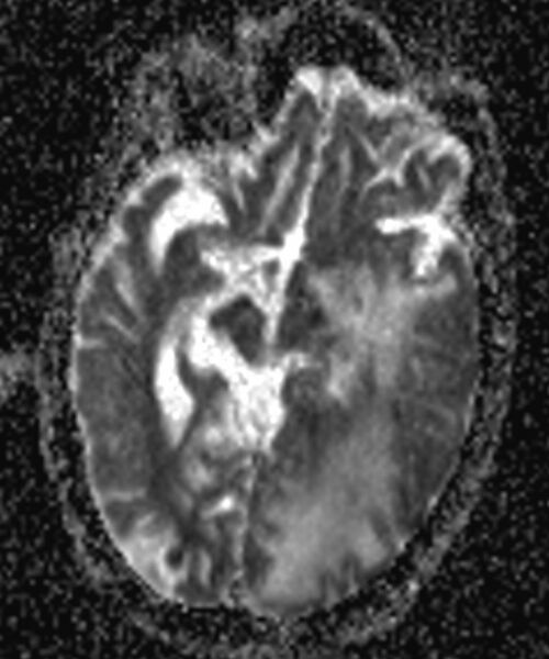 File:Brain abscess with dual rim sign (Radiopaedia 87566-103938 Axial ADC 8).jpg