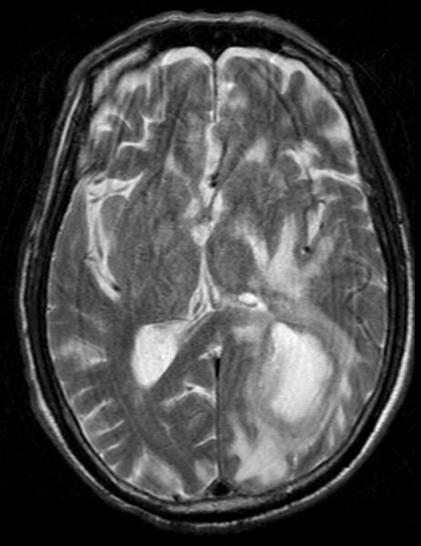 File:Brain abscess with dual rim sign (Radiopaedia 87566-103938 Axial T2 12).jpg