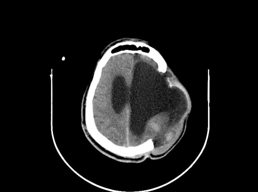 Brain injury by firearm projectile (Radiopaedia 82068-96088 A 157).jpg