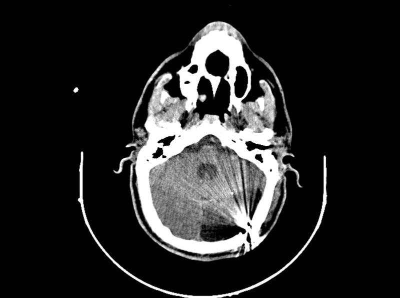 File:Brain injury by firearm projectile (Radiopaedia 82068-96088 A 87).jpg