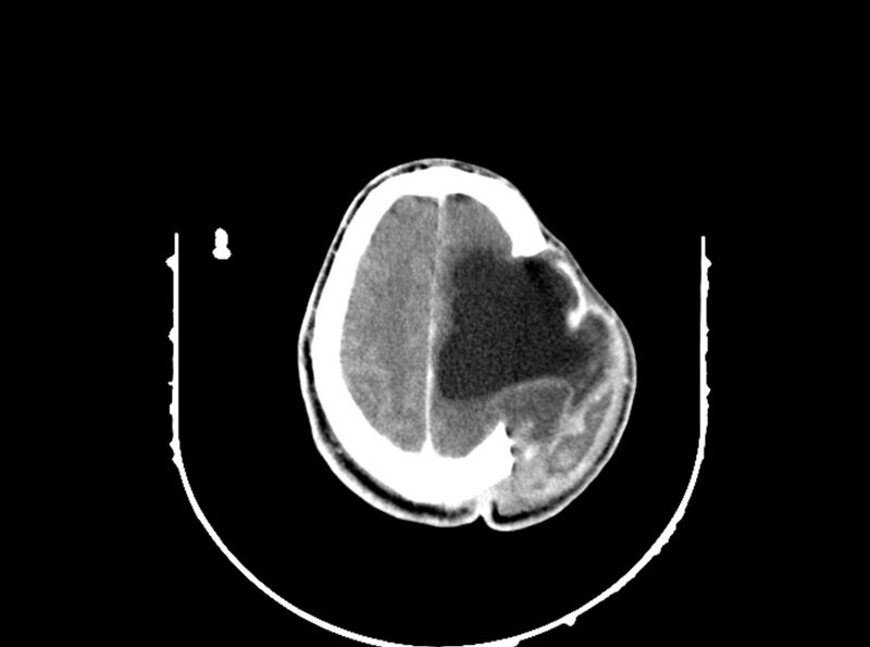 File:Brain injury by firearm projectile (Radiopaedia 82068-96088 B 175).jpg