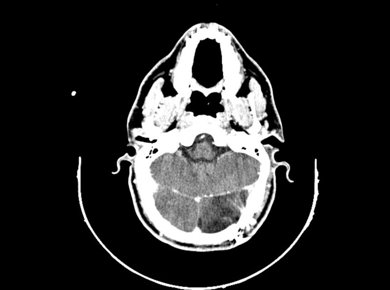 File:Brain injury by firearm projectile (Radiopaedia 82068-96088 B 81).jpg