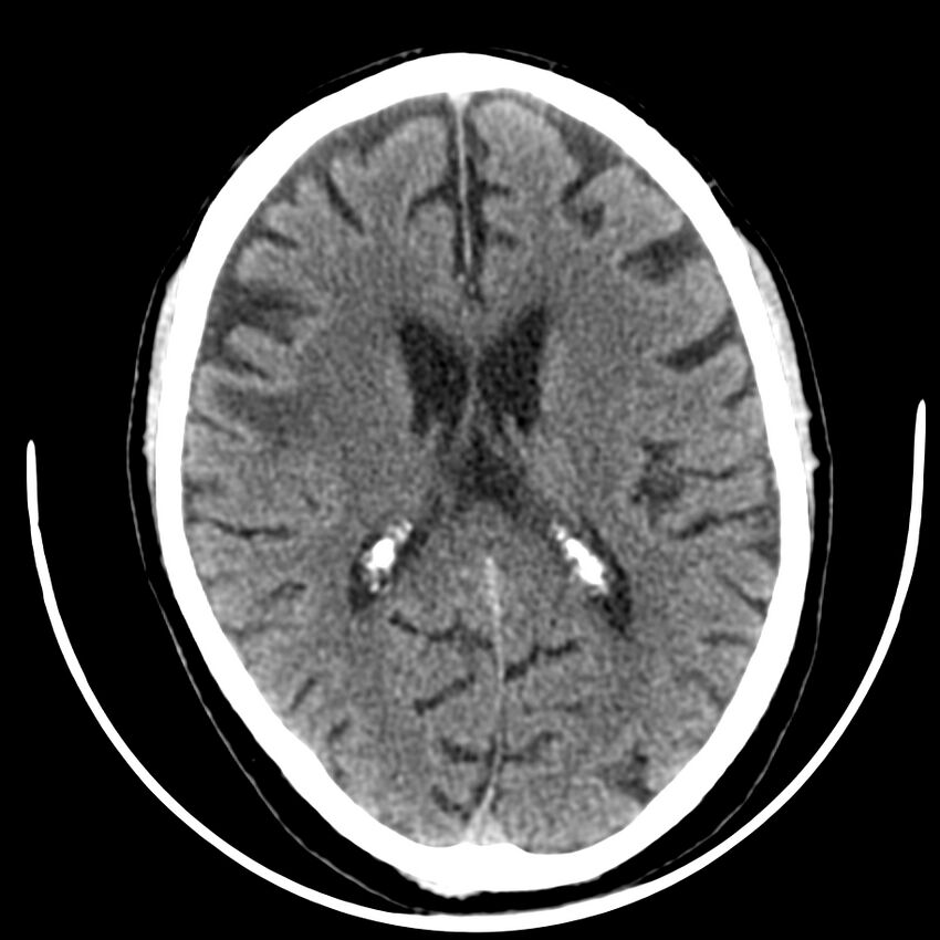 Brain metastasis (Radiopaedia 42617-45760 Axial non-contrast 27).jpg