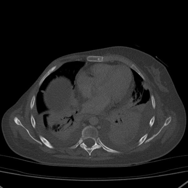 File:Breast cancer metastases - hepatic and skeletal (Radiopaedia 34201-35461 Axial bone window 23).jpg
