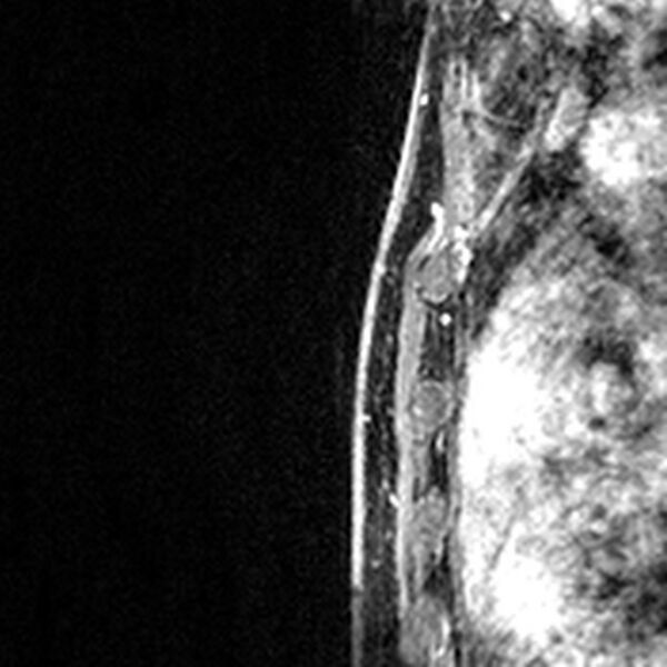 File:Breast implants - MRI (Radiopaedia 26864-27035 Sagittal T2 55).jpg