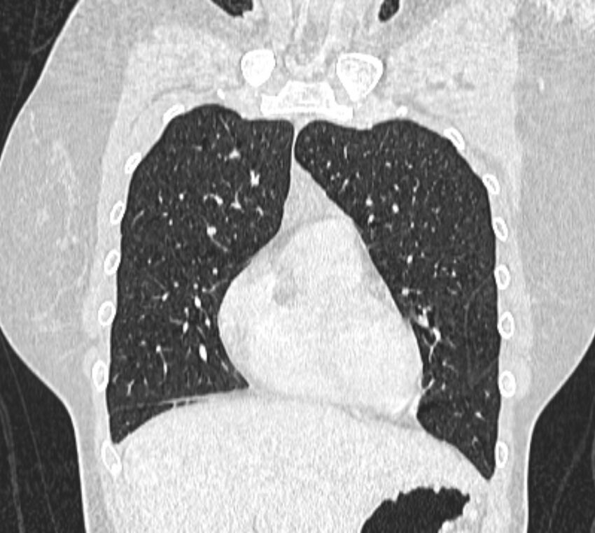 Bronchial atresia (Radiopaedia 50007-55297 Coronal lung window 22).jpg