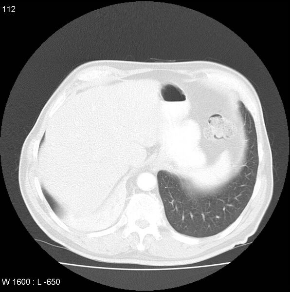 File:Bronchial carcinoid tumor with right lower lobe collapse (Radiopaedia 29060-29422 B 50).jpg