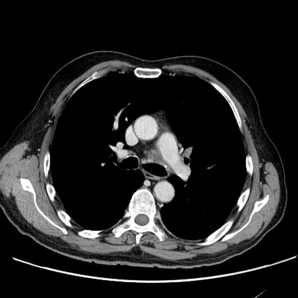File:Bronchogenic carcinoma with L1 vertebra metastasis (Radiopaedia 9096-9805 Axial C+ delayed 13).jpg