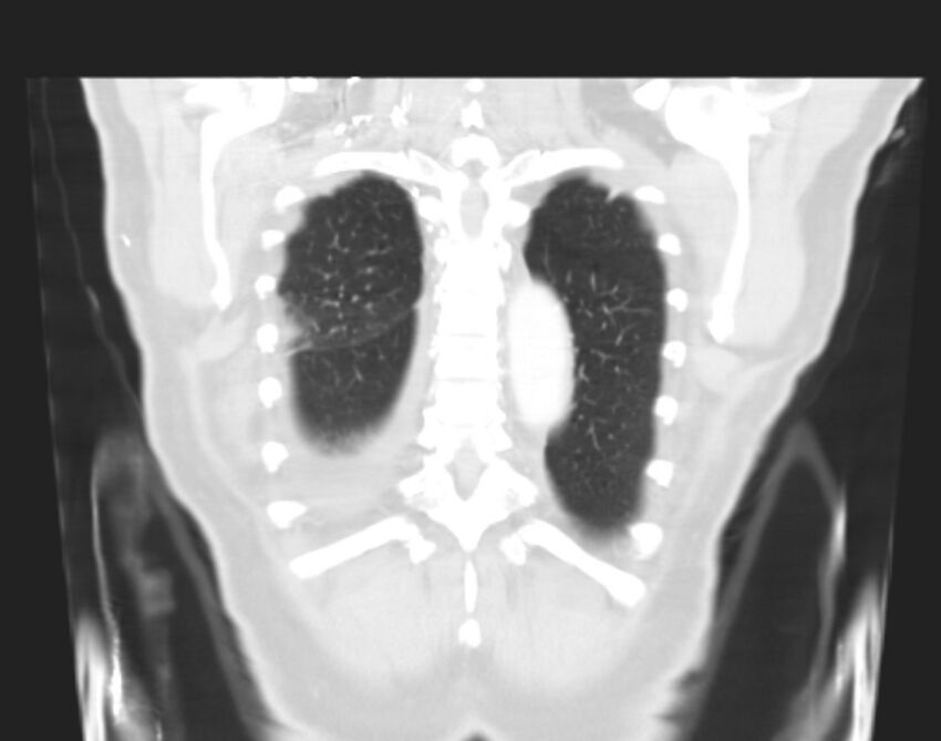 Bronchogenic carcinoma with lymphangitic spread (Radiopaedia 29002-29357 Coronal lung window 63).jpg