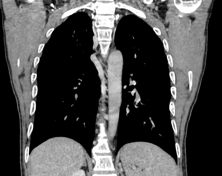 File:Bronchogenic carcinoma with superior vena cava syndrome (Radiopaedia 36497-38054 Coronal C+ delayed 78).jpg