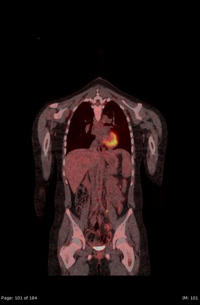 File:Brown fat uptake (FDG PET-CT) (Radiopaedia 77392-89513 Fused coronal 59).jpg