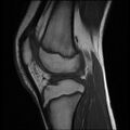 Bucket handle tear - lateral meniscus (Radiopaedia 72124-82634 Sagittal T1 6).jpg