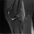 Bucket handle tear - lateral meniscus (Radiopaedia 7246-8187 Sagittal T2 fat sat 14).jpg