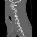 C5 facet fracture (Radiopaedia 58374-65499 Sagittal bone window 45).jpg