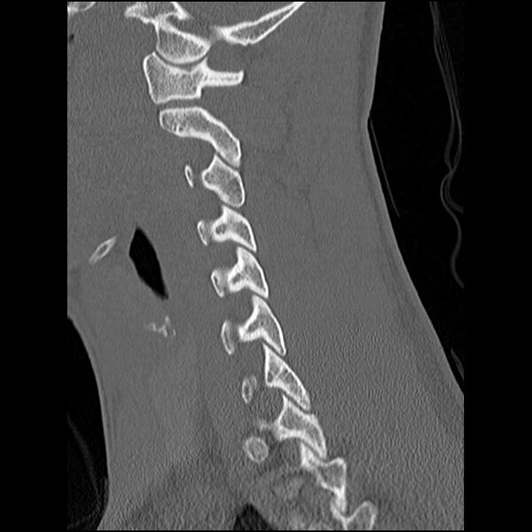 File:C5 facet fracture (Radiopaedia 58374-65499 Sagittal bone window 45).jpg