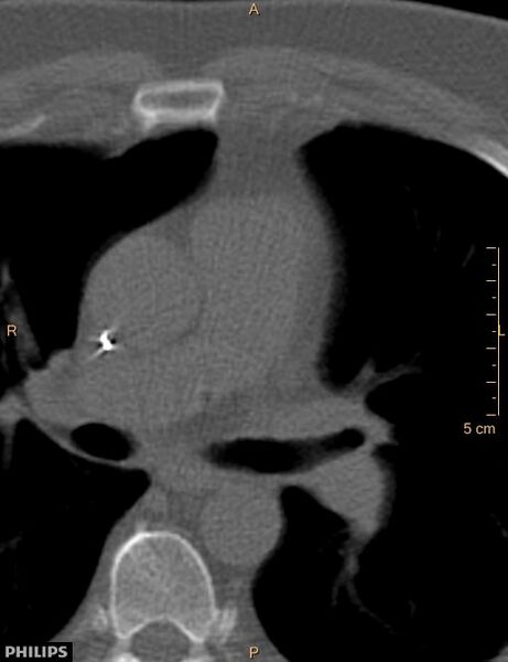 File:Calcified cardiac fibroma (Radiopaedia 39267-41519 Axial bone window 8).jpg