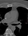 Calcified cardiac fibroma (Radiopaedia 39267-41519 Axial bone window 8).jpg
