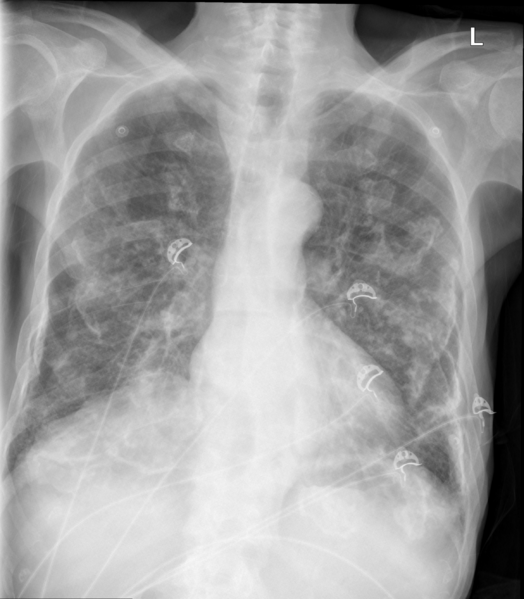 File:Calcified pleural plaques (Radiopaedia 43925).png