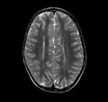 Callosal dysgenesis and ectopic posterior pituitary (Radiopaedia 8382-9213 Axial T2 3).jpg
