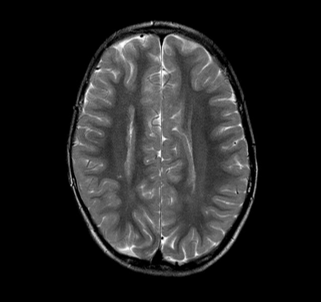 File:Callosal dysgenesis and ectopic posterior pituitary (Radiopaedia 8382-9213 Axial T2 3).jpg
