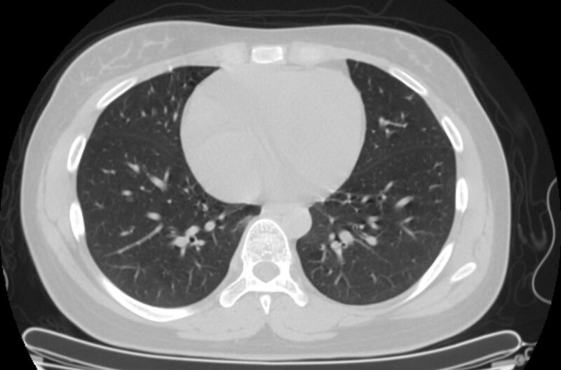 File:Cannonball metastases - uterine choriocarcinoma (Radiopaedia 70137-80173 Axial lung window 72).jpg