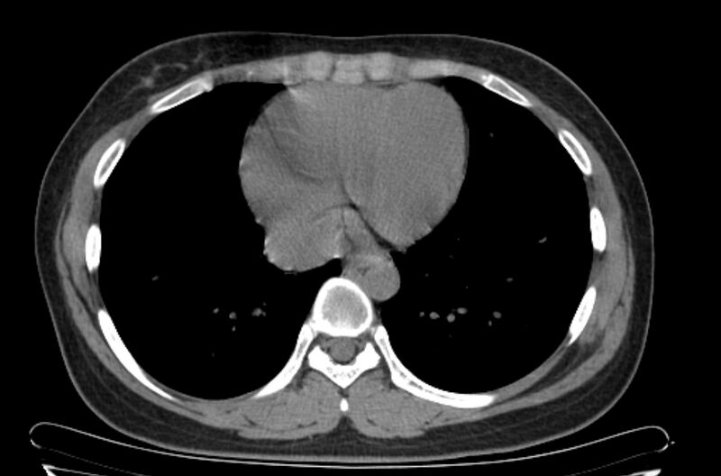 File:Cannonball metastases - uterine choriocarcinoma (Radiopaedia 70137-80173 Axial non-contrast 87).jpg