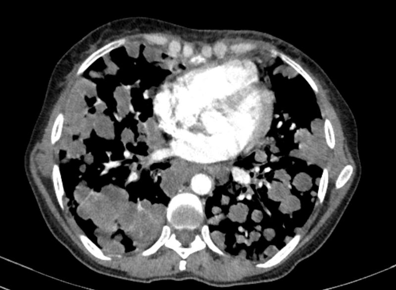 File:Cannonball metastases from breast cancer (Radiopaedia 91024-108569 A 75).jpg